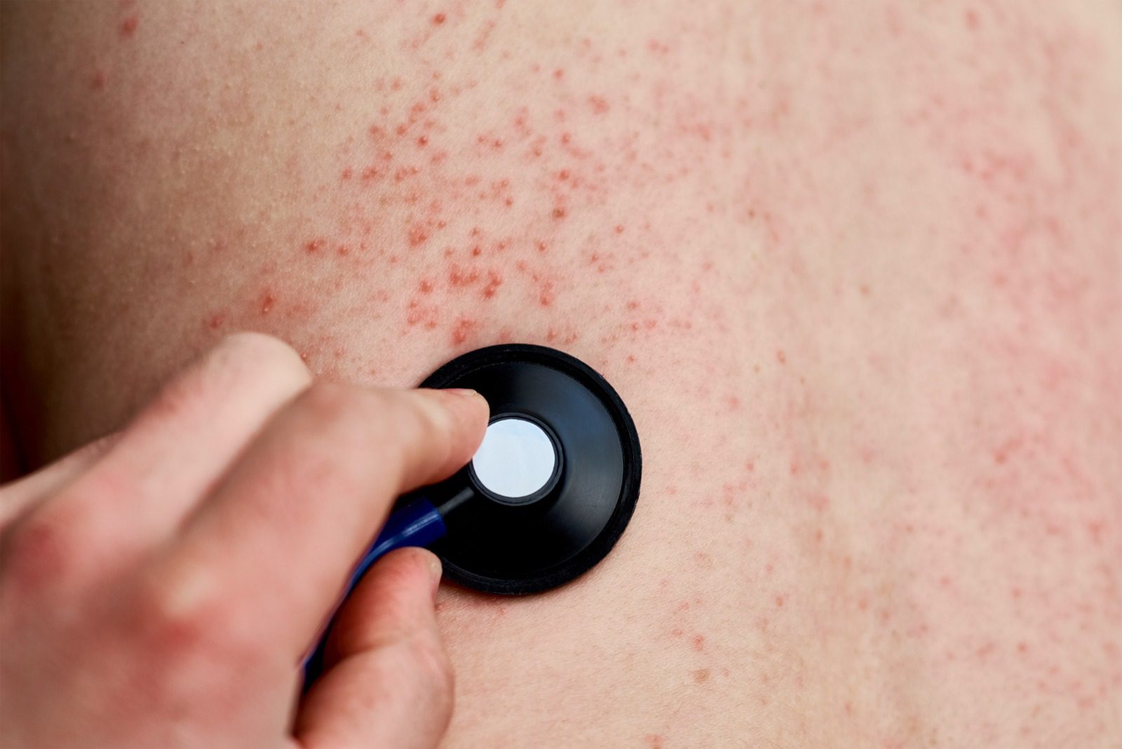 Las autoridades advierten sobre la alta capacidad de transmisión del virus, que ha tenido su pico de contagio en el departamento de Guatemala. (Foto: IGSS / AUN)