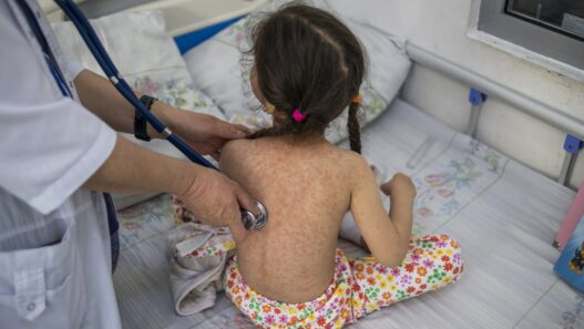 El Ministerio de Salud declaró una epidemia local de sarampión luego de confirmar más de 5,120 casos y cinco fallecimientos. (Foto: OMS / Soy502)