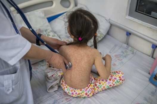 El Ministerio de Salud declaró una epidemia local de sarampión luego de confirmar más de 5,120 casos y cinco fallecimientos. (Foto: OMS / AUN)