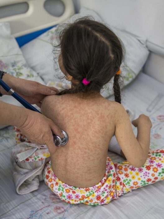 El Ministerio de Salud declaró una epidemia local de sarampión luego de confirmar más de 5,120 casos y cinco fallecimientos. (Foto: OMS / AUN)