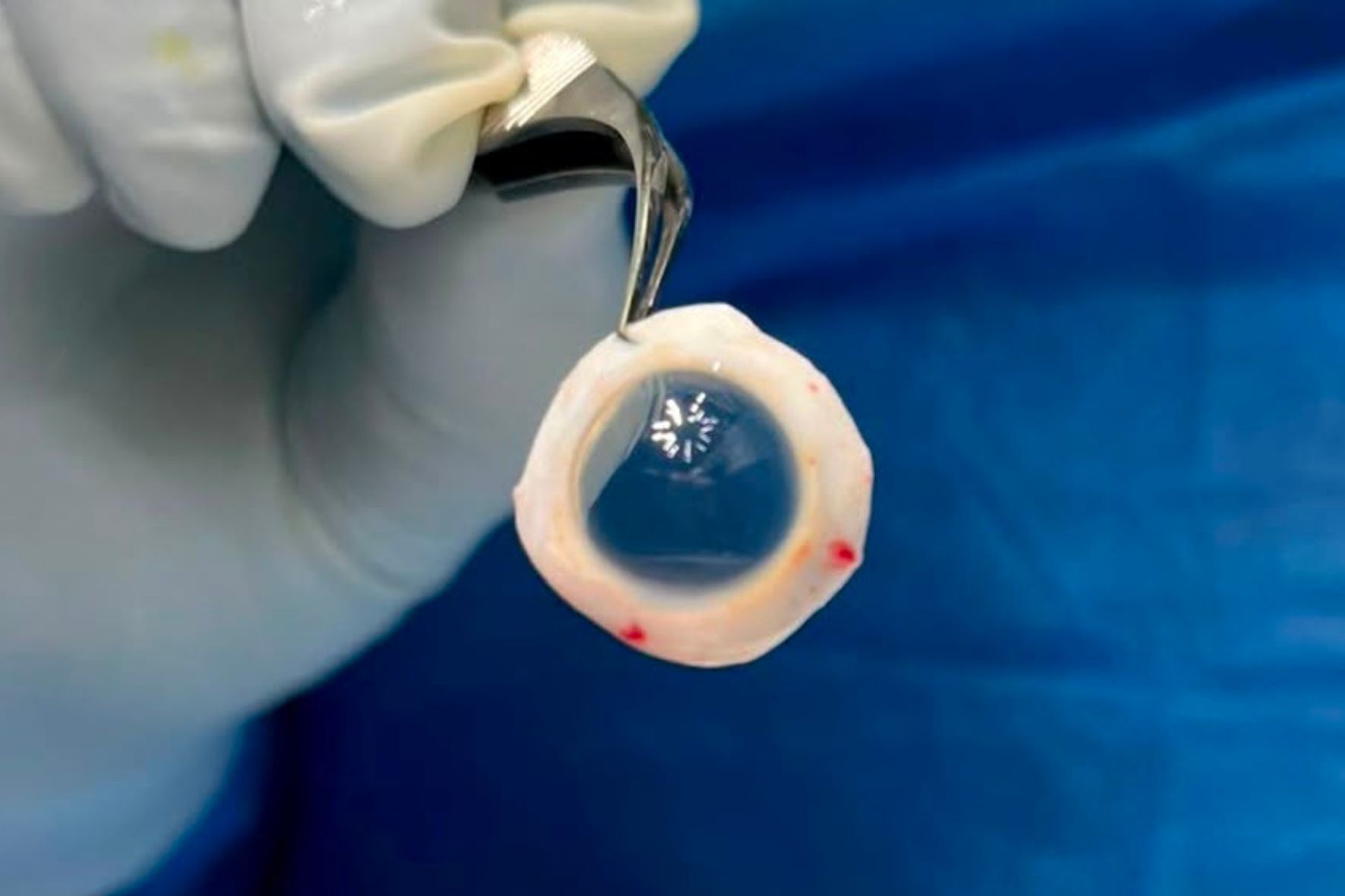 Según la Fundación Donaré y el Ministerio de Salud Pública, un donante vivo o fallecido puede salvar ocho vidas. (Foto: Fundación Daré / AUN)